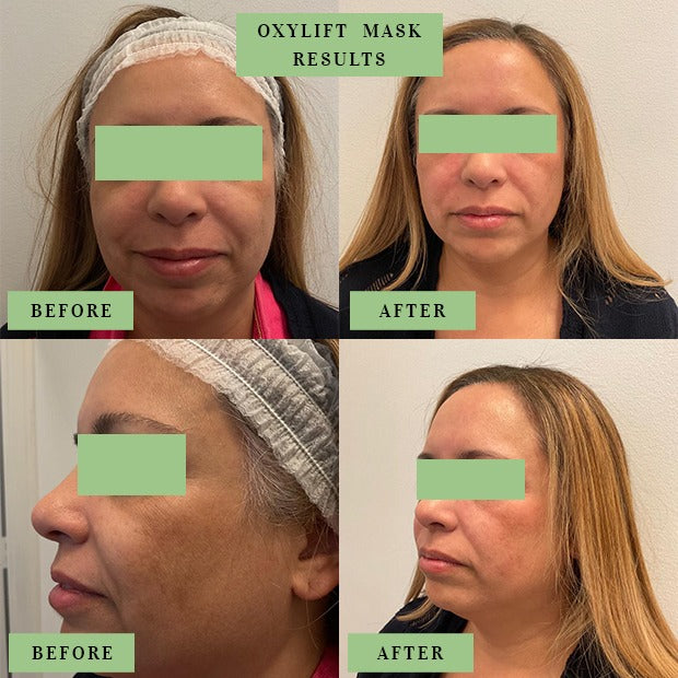kavita life oxygen gel face neck mask before and after